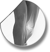 Indications for knee arthroscopy