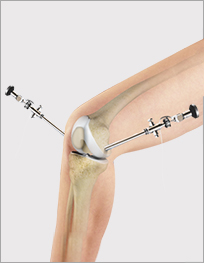 Knee Arthroscopy